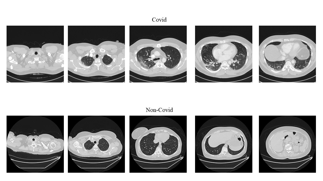 胸腔電腦斷層掃描影像(CT scan), 下為未確診者、上為確診者。許志仲提供